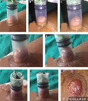 Cover image of the article: Surgical Pearl: Small Suction Syringe for Producing Blister