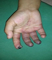 Cover image of the article: Nicolau Syndrome Following Intralesional Sclerotherapy: A Dreaded Complication of a Simple Office Procedure