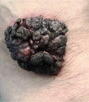 Giant Seborrheic Keratosis on the Right Flank Part: A Case Report