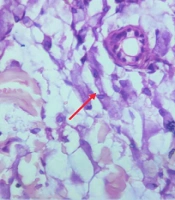 Cutaneous Metastasis of Signet Ring Cell Carcinoma: An Unusual Case Report