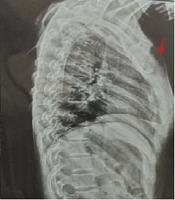 Cover image of the article: Presternal Scrofuloderma: Tip of the Iceberg Unveiling Multifocal Extrapulmonary Tuberculosis - A Rare Case Report