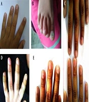 Nail Changes following Hand-Foot-Mouth Disease in North India