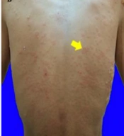 Antituberculosis Drug-induced Linear IgA Dermatosis