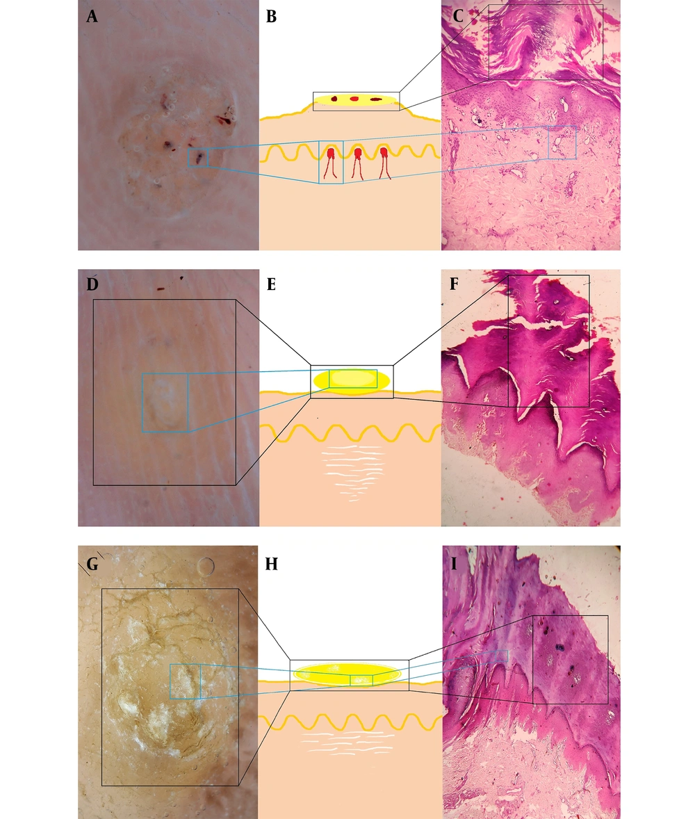 Schematic diagram showing a dermoscopic and histopathological correlation in plantar wart (A, B & C). Schematic diagram showing a dermoscopic and histopathological correlation in corn (D, E & F). Schematic diagram showing a dermoscopic and histopathological correlation in callus (G, H & I). Schematic diagram showing a dermoscopic and histopathological correlation in plantar wart (A, B & C). Schematic diagram showing a dermoscopic and histopathological correlation in corn (D, E & F). Schematic diagram showing a dermoscopic and histopathological correlation in callus (G, H & I).