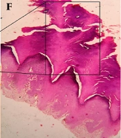 Plantar Papules and Plaques: A Dermoscopic-Histopathological Correlation