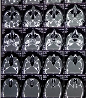 Facial Ulcer: A Harbinger of Post-COVID-19 Mucormycosis, a Case Report