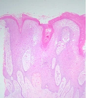 Warty Lesion Over Amputated Stump