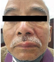 A Clinico-Epidemiological Study of Cases of Herpes Zoster in a Tertiary Care Hospital