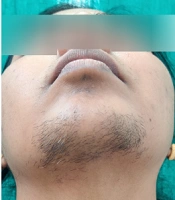 Impact of Hirsutism on the Quality of Life: A Cross-sectional Pilot Study Using Dermatology Life Quality Index from Western India