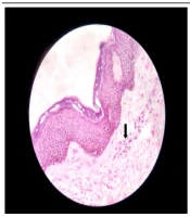Sunitinib-Induced Cutaneous Small-Vessel Vasculitis: A Rare Case Report