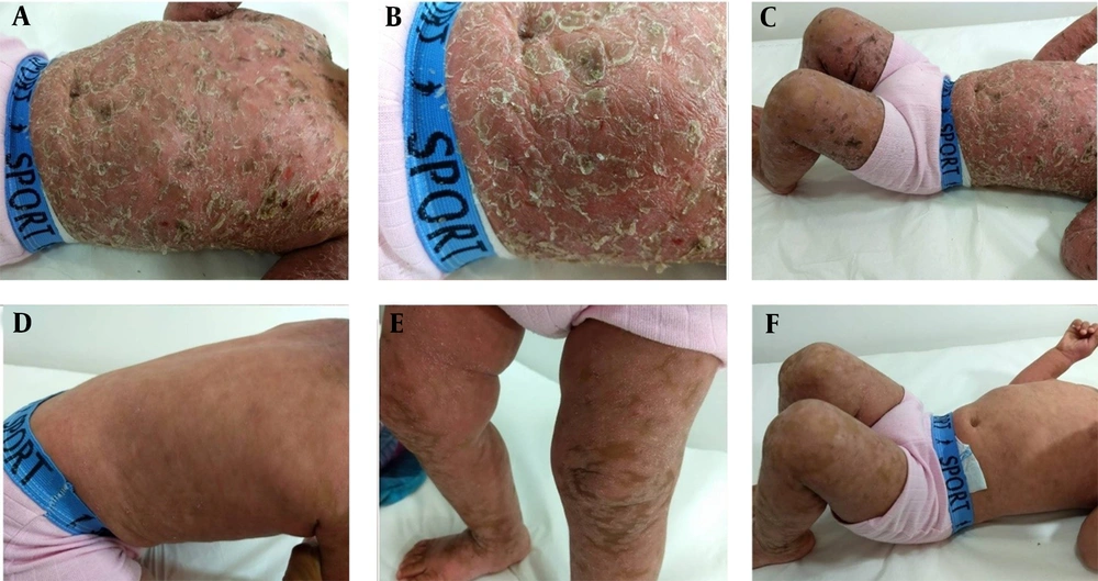 A, B and C, Erythrodermic clinical picture, with xerosis and desquamation in thick brownish scales, which adhered to the center and had raised edges; absence of ectropion or eclabium; C, D and E, Improvement in the patient's condition following the suspension of topical medications. A, B and C, Erythrodermic clinical picture, with xerosis and desquamation in thick brownish scales, which adhered to the center and had raised edges; absence of ectropion or eclabium; C, D and E, Improvement in the patient's condition following the suspension of topical medications.