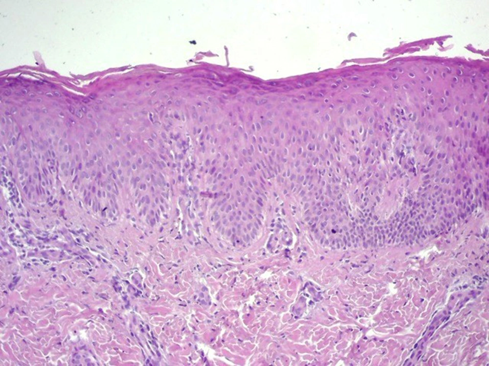 Microscopy: Compact hyperkeratosis, with parakeratosis, without alteration of the granular layer, accompanied by regular acanthosis Microscopy: Compact hyperkeratosis, with parakeratosis, without alteration of the granular layer, accompanied by regular acanthosis