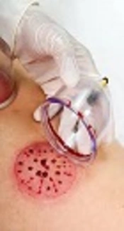 Effects of Wet Cupping on Blood Components Specially Skin-Related Parameters of Healthy Cases: A Case Control Metabonomic Study