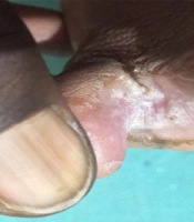 Therapeutic Pearl: Cyanoacrylate Glue is a Good Thermo-dehydro-anti-infective Sealing Agent for Treating Chronic Interdigital Intertrigo
