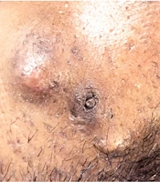 Innovative Use of a Disposable Syringe Barrel as a Device to Drain a Cyst