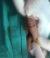 Helical Rim Advancement Flap and Its Implication in the Skin Cancer of the Auricle: A Case Report