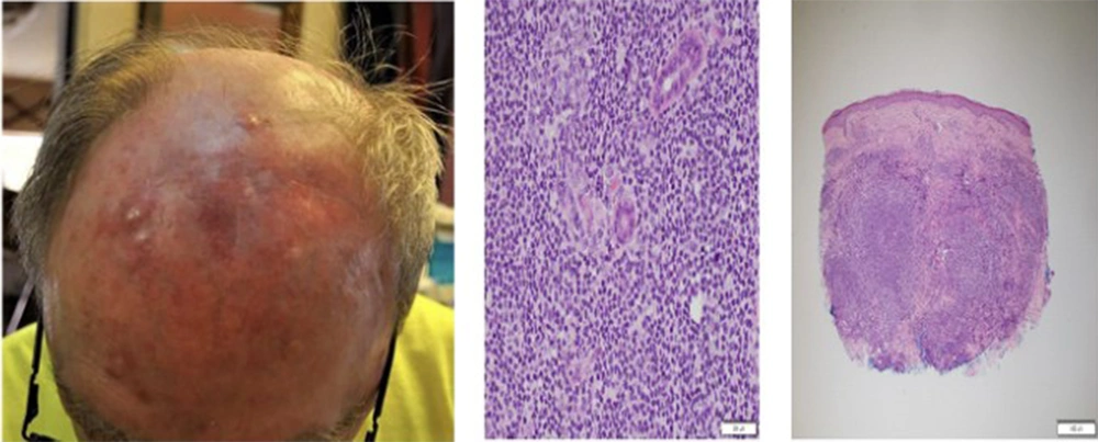 Clinical manifestation of primary cutaneous B-cell lymphoma as scalp erythema and nodules, and histopathology Clinical manifestation of primary cutaneous B-cell lymphoma as scalp erythema and nodules, and histopathology