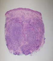 Scalp Erythema and Nodules: Would You Think of Primary Cutaneous Follicle Center B-Cell Lymphoma If a Biopsy is Inconclusive?