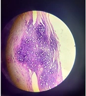 Debilitating Contractures of Hands in an Atypical Presentation of Juvenile Pityriasis Rubra Pilaris: A Rare Case Report