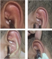Modified Hypodermic Needle for Injection into the Concha and Fossa of the Pinna