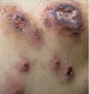 Dramatic Response of Rapid Progressive Atypical Pyoderma Gangrenosum to Infliximab in a Patient with Ulcerative Colitis