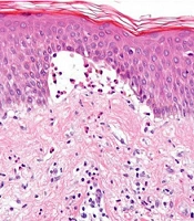 Unusual Presentations of Bullous Pemphigoid in Young Patients: A Case Series