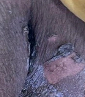 Mucocutaneous Ulcerations Due to Methotrexate Toxicity Mimicking Vesiculobullous Disorder: A Diagnostic Challenge