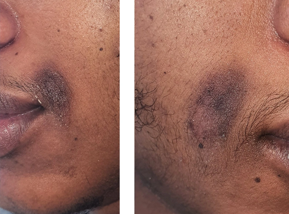 Bilateral Symmetrical Oval Hyperpigmentation on the Face: A Case of  Seborrheic Melanosis