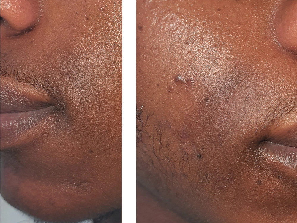 melanotic hyperpigmentation Bilateral Symmetrical Oval Hyperpigmentation on the Face: A Case of  Seborrheic Melanosis