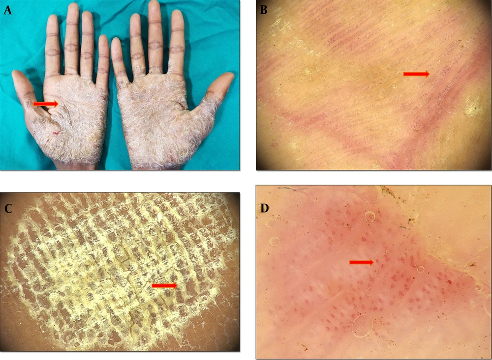 A, erythematous scaly plaques of psoriasis distributed symmetrically over the palms, B, dermoscopy features of palmoplantar psoriasis, showing regular dotted vessels (the red arrow), C, dermoscopy features of palmoplantar psoriasis, showing characteristic diffused white scales (the red arrow) with a dull-red background, D, dermoscopy findings showing irregularly spaced rows of glomerular vessels (the red arrow) (Medicam1000, 20x). A, erythematous scaly plaques of psoriasis distributed symmetrically over the palms, B, dermoscopy features of palmoplantar psoriasis, showing regular dotted vessels (the red arrow), C, dermoscopy features of palmoplantar psoriasis, showing characteristic diffused white scales (the red arrow) with a dull-red background, D, dermoscopy findings showing irregularly spaced rows of glomerular vessels (the red arrow) (Medicam1000, 20x).