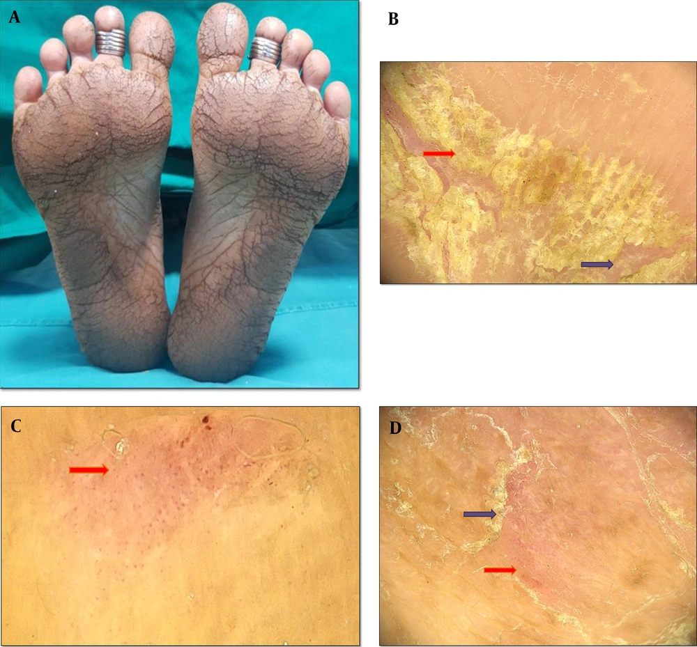 A, hyperkeratotic scaly eczematous plaques with fissures distributed symmetrically over the plantar aspect of feet, B, dermoscopy findings of palmoplantar dermatitis showing patchy yellow (red) and white (purple) scales, C, dermoscopy examination showing dotted vessels (red) with a patchy distribution behind a light-red background, D, dermoscopy examination showing dotted vessels (the red arrow) in with clustered distribution and peripheral scales (the purple arrow) (Medicam1000, 20x). A, hyperkeratotic scaly eczematous plaques with fissures distributed symmetrically over the plantar aspect of feet, B, dermoscopy findings of palmoplantar dermatitis showing patchy yellow (red) and white (purple) scales, C, dermoscopy examination showing dotted vessels (red) with a patchy distribution behind a light-red background, D, dermoscopy examination showing dotted vessels (the red arrow) in with clustered distribution and peripheral scales (the purple arrow) (Medicam1000, 20x).