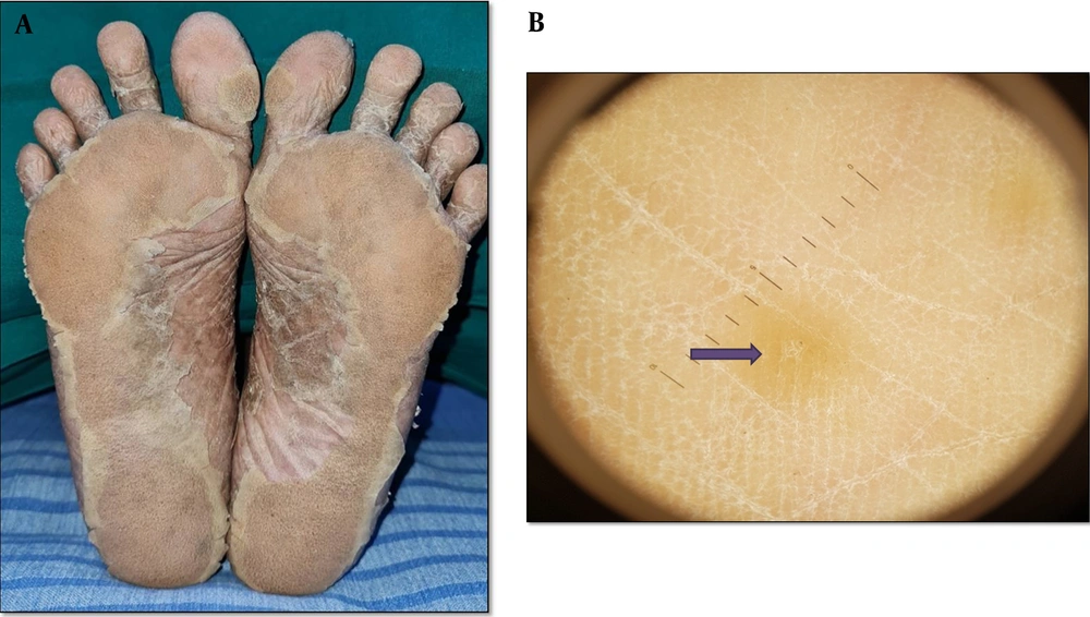 A, hyperkeratotic scaly plaques (PRP sandal) distributed symmetrically over both soles, B, dermoscopy findings in PRP, showing homogenous structure with less orange areas (the purple arrow) (Heine delta 20+, 20x). A, hyperkeratotic scaly plaques (PRP sandal) distributed symmetrically over both soles, B, dermoscopy findings in PRP, showing homogenous structure with less orange areas (the purple arrow) (Heine delta 20+, 20x).