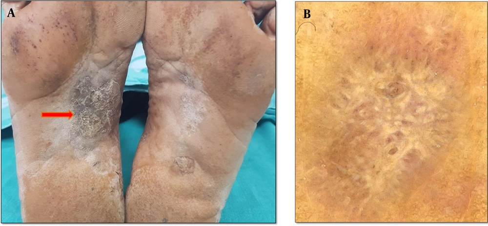 A, violaceous scaly plaques of lichen planus distributed over the instep (the red arrow) and plantar area of both feet; B, dermoscopy findings in lichen planus, showing Wickham’s striae (the purple arrow) and peripheral linear and dotted vessels (the red arrow) (Medicam1000, 20x). A, violaceous scaly plaques of lichen planus distributed over the instep (the red arrow) and plantar area of both feet; B, dermoscopy findings in lichen planus, showing Wickham’s striae (the purple arrow) and peripheral linear and dotted vessels (the red arrow) (Medicam1000, 20x).