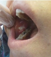 Cover image of the article: Immediate Analgesic Effect of Non-thermal CO2 Laser Therapy (NTCLT) on Oral Ulcers in a Kidney Transplant Patient with Leukopenia