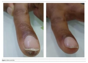 Bleomycin Tatooing for Periungual Verruca