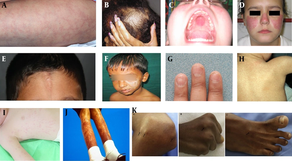 A, Livedo reticularis; B, Scalp with Diffuse Alopecia; C, Oral Ulcer of SLE; D, Malar Rash of SLE; E, En coup de sabre in scleroderma; F, Parry-Romberg syndrome: Atrophy of facial tissues; G, Nail involvement in PsJIA; H, Colored dirty mildly scaly rash in Blau syndrome; I, Salmon pink-macular rash in SoJIA; J, Subcutaneous nodule in sarcoidosis; K, Subcutaneous Nodules in Acute Rheumatic Fever. A, Livedo reticularis; B, Scalp with Diffuse Alopecia; C, Oral Ulcer of SLE; D, Malar Rash of SLE; E, En coup de sabre in scleroderma; F, Parry-Romberg syndrome: Atrophy of facial tissues; G, Nail involvement in PsJIA; H, Colored dirty mildly scaly rash in Blau syndrome; I, Salmon pink-macular rash in SoJIA; J, Subcutaneous nodule in sarcoidosis; K, Subcutaneous Nodules in Acute Rheumatic Fever.