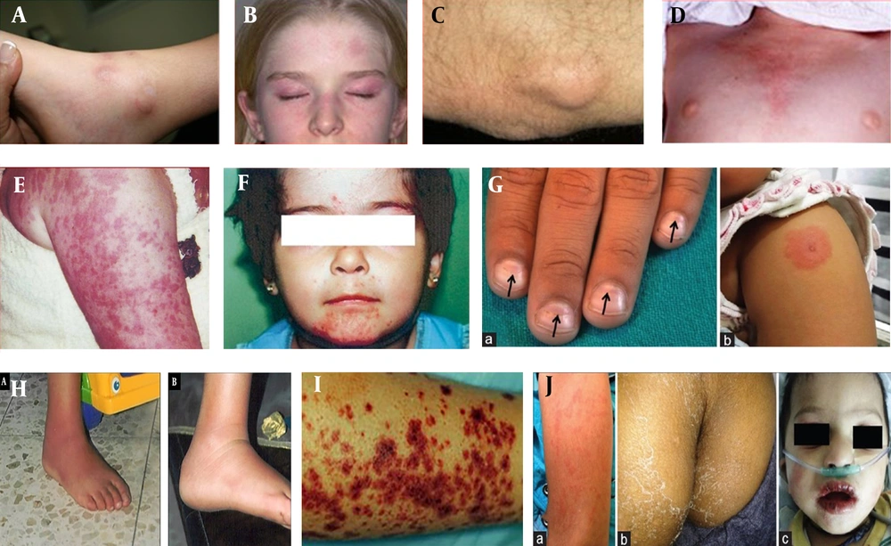 A, Nodular lesion in PAN; B, Skin Rash in JDM; C, Skin calcinosis in JDM; D, Shawl Sign in JDM; E, Urticarial-like appearance in CAPS; F, Acne-like lesions in Behcet's disease; G, Beau lines and induration at BCG inoculation site; H, Rash over extremities, Perianal desquamation, Dry, reddened, and vertically cracked lips; I, Henoch-Schonlein purpura; J, Erysipelas-like erythema, and a full spontaneous in FMF. A, Nodular lesion in PAN; B, Skin Rash in JDM; C, Skin calcinosis in JDM; D, Shawl Sign in JDM; E, Urticarial-like appearance in CAPS; F, Acne-like lesions in Behcet's disease; G, Beau lines and induration at BCG inoculation site; H, Rash over extremities, Perianal desquamation, Dry, reddened, and vertically cracked lips; I, Henoch-Schonlein purpura; J, Erysipelas-like erythema, and a full spontaneous in FMF.