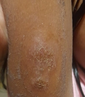 Cover image of the article: Cutaneous Adverse Drug Reactions to Antidiabetic Medications and Medical Devices Used in Management of Diabetes Mellitus
