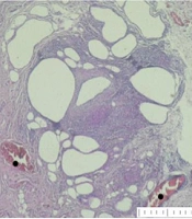 Cover image of the article: Are Preadipocytes More Advantageous Than Adipocytes in Soft Tissue Augmentation?