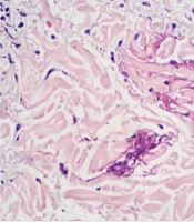 Cover image of the article: Wells Syndrome Associated with Fungal Infection