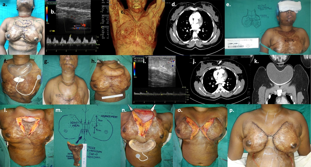 a, planning for tissue expansion of a 24-year-old female with post-burn scar on breasts & symmastia; b, pre-expansion colour doppler; c & d, pre-expansion CT angiography; e, pre-operative planning & rationale of 1 croissant shaped expander in pre-sternal area estimating area of advancement in terms of volume and dimensions of the expander (croissant 250 cc, 14.5 × 7.7 × 4.5 cm); f, expander inserted after creating the pocket; g, early post-operative image after 3 days; h, after 6 sessions of expansion (240 cc) over 2 months; i, post-expansion colour doppler; j & k, CT- angiography with 3-dimensional reconstruction post-expansion; l, removal of expander through excision of scar in the pre-sternal and inter-mammary area; m, excised scar; n, expander removed with remote port; o, expanded skin advanced inferiorly and wound closed creating adequate inter-mammary area; p, early post-operative image after 7 days. a, planning for tissue expansion of a 24-year-old female with post-burn scar on breasts & symmastia; b, pre-expansion colour doppler; c & d, pre-expansion CT angiography; e, pre-operative planning & rationale of 1 croissant shaped expander in pre-sternal area estimating area of advancement in terms of volume and dimensions of the expander (croissant 250 cc, 14.5 × 7.7 × 4.5 cm); f, expander inserted after creating the pocket; g, early post-operative image after 3 days; h, after 6 sessions of expansion (240 cc) over 2 months; i, post-expansion colour doppler; j & k, CT- angiography with 3-dimensional reconstruction post-expansion; l, removal of expander through excision of scar in the pre-sternal and inter-mammary area; m, excised scar; n, expander removed with remote port; o, expanded skin advanced inferiorly and wound closed creating adequate inter-mammary area; p, early post-operative image after 7 days.
