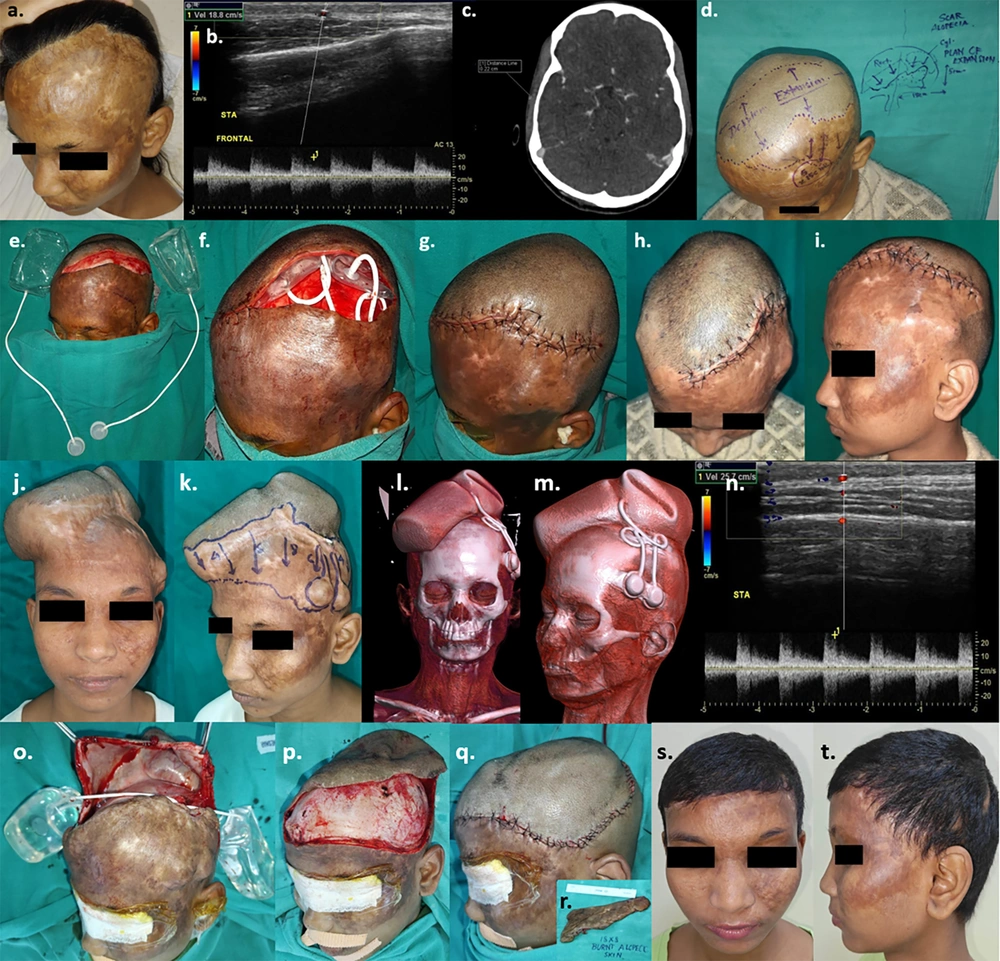 a, 19-year-old girl with post-burn scar & alopecia scalp; b, pre-expansion colour doppler; c, pre-expansion CT angiography; d, pre-operative planning of 2 expanders estimating area of advancement in terms of volume and dimensions of the expanders (cylindrical on rt. side of scalp- 250 cc, 10.2 × 5.4 × 7.2 cm and rectangular on lt. side of scalp- 300 cc, 10 × 6 × 6.3 cm); e & f, expanders inserted after creating sub-galeal pockets; g, closure of wound; h & i, early post-operative image after 1 week; j & k, After completion of expansion (240 cc on right side & 280 cc on left side) over 4 months; l & m, 3-dimensional reconstruction of CT images post-expansion; n, colour doppler post-expansion; o, to q, expander removal and definitive wound closure after excision of alopecic scar 18 × 8 cm (<a href="#A153518FIG2">Figure 2</a>. r. inset); s & t, late post-operative results after 3 months. a, 19-year-old girl with post-burn scar & alopecia scalp; b, pre-expansion colour doppler; c, pre-expansion CT angiography; d, pre-operative planning of 2 expanders estimating area of advancement in terms of volume and dimensions of the expanders (cylindrical on rt. side of scalp- 250 cc, 10.2 × 5.4 × 7.2 cm and rectangular on lt. side of scalp- 300 cc, 10 × 6 × 6.3 cm); e & f, expanders inserted after creating sub-galeal pockets; g, closure of wound; h & i, early post-operative image after 1 week; j & k, After completion of expansion (240 cc on right side & 280 cc on left side) over 4 months; l & m, 3-dimensional reconstruction of CT images post-expansion; n, colour doppler post-expansion; o, to q, expander removal and definitive wound closure after excision of alopecic scar 18 × 8 cm (<a href="#A153518FIG2">Figure 2</a>. r. inset); s & t, late post-operative results after 3 months.