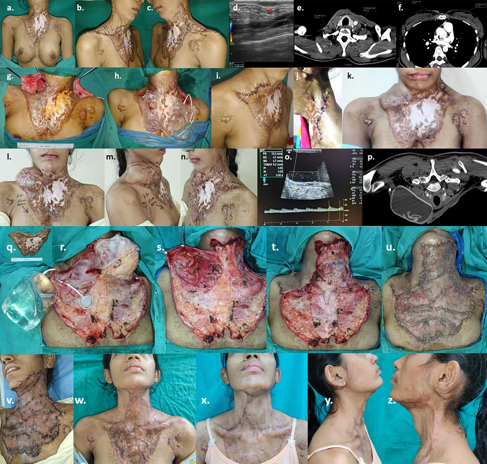 a to c, Planning for tissue expansion of a 23-year-old female with post-burn neck contracture (Grade III) and upper chest wall hypertrophic hypopigmented scar; d, pre-expansion colour doppler; e & f, pre-expansion CT angiography; g & h, insertion of 2 expanders estimating area of advancement in terms of volume and dimensions of the expanders (cylindrical on rt. supraclavicular region- 250 cc, 10.2 × 5.4 × 7.2 cm and rectangular on lt. supraclavicular region- 300 cc, 10 × 6 × 6.3 cm); i, early post-operative images after 2 weeks; j & k, left sided implant extrusion due to infection & suture dehiscence after 4 weeks following which left sided expander removed; l to n, after 7 sessions of expansion (280 cc) on the right sided expander over 4 months; o, post-expansion colour doppler; p, post-expansion CT-angiography with 3-dimensional reconstruction; q, Excision of post-burn scar and removal of expander; r to t, defect on neck & upper chest after excisional release and advancement of right sided supraclavicular expanded skin; u, defect resurfaced with intermediate thickness split skin graft; v, early post-operative image - 5th post-operative day; w, 4 weeks post-op ; x to z, 3 months post – op with adequate neck extension & cervico-mental angle. a to c, Planning for tissue expansion of a 23-year-old female with post-burn neck contracture (Grade III) and upper chest wall hypertrophic hypopigmented scar; d, pre-expansion colour doppler; e & f, pre-expansion CT angiography; g & h, insertion of 2 expanders estimating area of advancement in terms of volume and dimensions of the expanders (cylindrical on rt. supraclavicular region- 250 cc, 10.2 × 5.4 × 7.2 cm and rectangular on lt. supraclavicular region- 300 cc, 10 × 6 × 6.3 cm); i, early post-operative images after 2 weeks; j & k, left sided implant extrusion due to infection & suture dehiscence after 4 weeks following which left sided expander removed; l to n, after 7 sessions of expansion (280 cc) on the right sided expander over 4 months; o, post-expansion colour doppler; p, post-expansion CT-angiography with 3-dimensional reconstruction; q, Excision of post-burn scar and removal of expander; r to t, defect on neck & upper chest after excisional release and advancement of right sided supraclavicular expanded skin; u, defect resurfaced with intermediate thickness split skin graft; v, early post-operative image - 5th post-operative day; w, 4 weeks post-op ; x to z, 3 months post – op with adequate neck extension & cervico-mental angle.