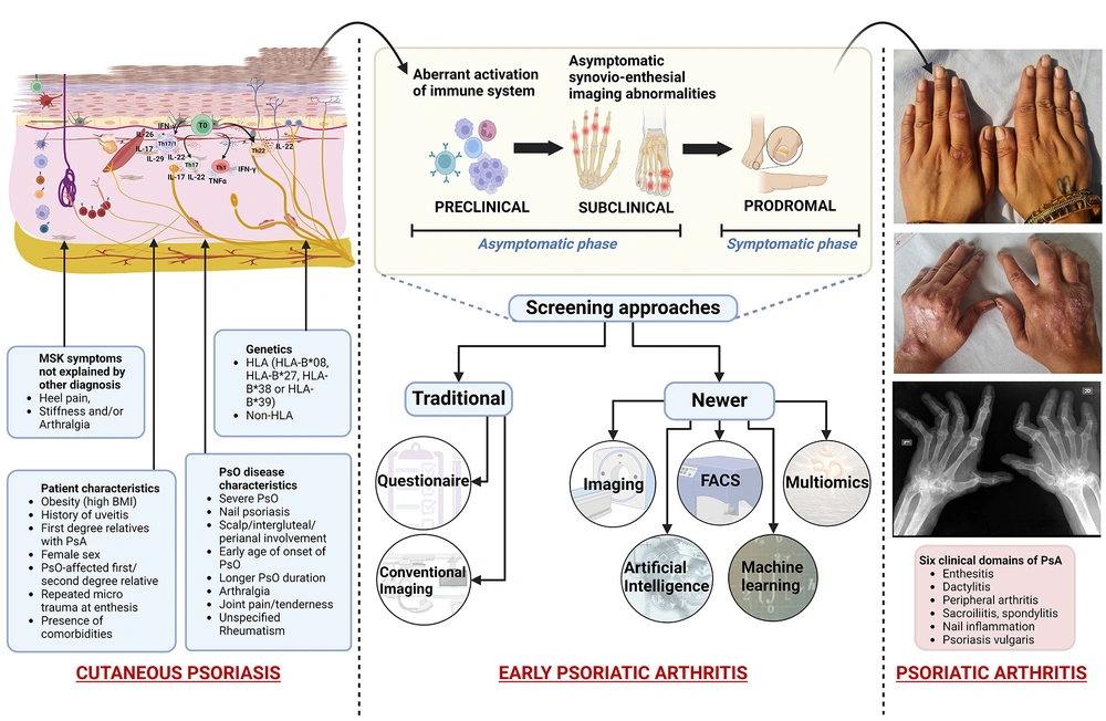 PsO-to-PsA continuum depicting predictive indicators (clinical and imaging features with risk factors) for progression to PsA. “Created with BioRender.com”. PsA, psoriatic arthritis; PsO, psoriatic arthritis; 'HLA, human leukocyte antigen; MSK, musculoskeletal; BMI, body mass index; FACS, fluorescence-activated cell sorting analysis. PsO-to-PsA continuum depicting predictive indicators (clinical and imaging features with risk factors) for progression to PsA. “Created with BioRender.com”. PsA, psoriatic arthritis; PsO, psoriatic arthritis; 'HLA, human leukocyte antigen; MSK, musculoskeletal; BMI, body mass index; FACS, fluorescence-activated cell sorting analysis.