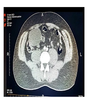 Right Mesocolic Dermoid Cyst: A Case Report and Literature Review