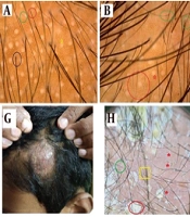 Trichoscopic Hallmarks in Non-cicatricial and Cicatricial Alopecia in Indian Population: A Narrative Review