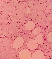 Rare Myxolipoma of the Foot in a Child: A Case Report