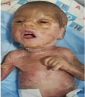 Isotretinoin, a Boon for Collodion Babies: A Case Series