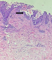 Pemphigus Vulgaris with Pyoderma Gangrenosum: An Unusual Association or a Coincidence?