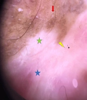 Penile Squamous Cell Carcinoma Complicating Lichen Sclerosus: A Case Report